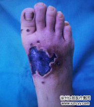 長了“刺瘊子”怎么辦？輕信“偏方”不僅治不了病，可能還會害了你