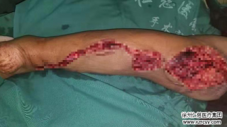 車禍傷后10小時，奔波500里，原本要截肢的腿在這保住了！