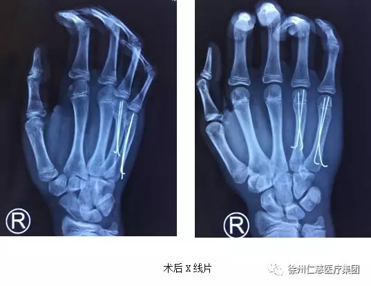 術后