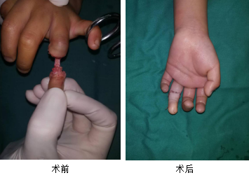 <a href='http://www.lnzszx.com/' target='_blank'><u>徐州仁慈醫(yī)院</u></a>手外科