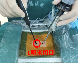 脊柱雙通道內(nèi)鏡“出手”，1cm微創(chuàng)切口解決腰椎間盤突出癥
