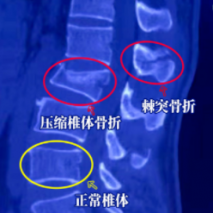 天璣骨科機器人輔助骨科微創(chuàng)手術(shù) 5個“小孔”修復(fù)腰椎骨折