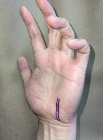 騎行60公里，她“累”到捏不起筷子 | 這是神經(jīng)損傷，可能需手術(shù)！